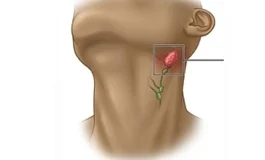 Uzmanından uyarı! Lenf nodu büyümesi ve şişliği pek çok hastalığın belirtisi olabilir