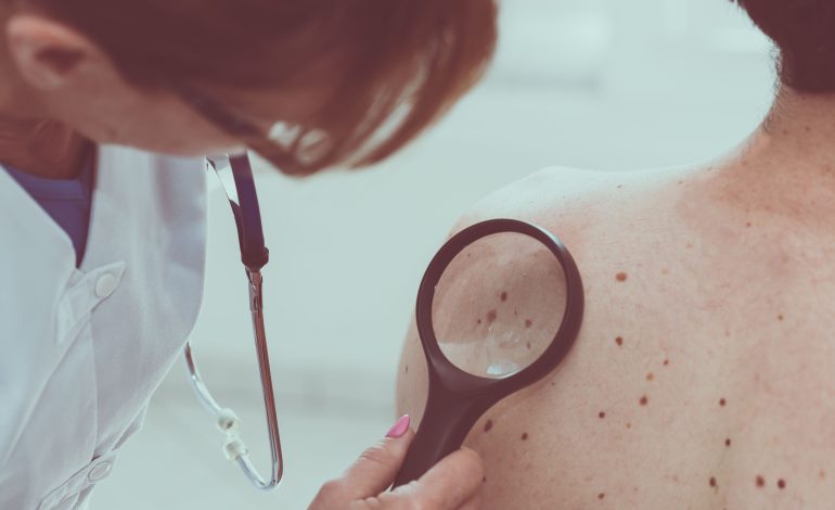 Melanom Nedir? Cilt Kanserinin Belirtileri ve Tedavi Seçenekleri Nelerdir?