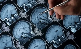 Alzheimer hastalığı nasıl başlar? İşte ilk belirtiler