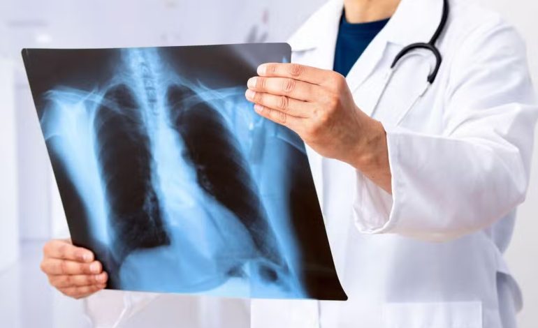 İleri evre akciğer kanseri menopoz öncesi kadınlarda daha sık görülüyor