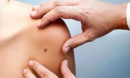 28 ilde cilt kanserine karşı ücretsiz 'ben' taraması yapılacak