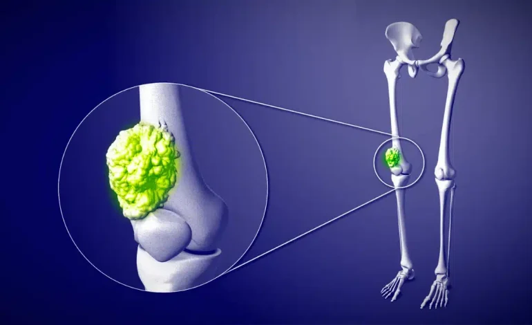 Geçmeyen kemik ağrısı ve şişliklere dikkat: Altından tümör çıkabilir!
