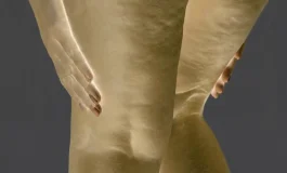 Lipödem geni: Kilo veremiyorsanız suçlu iradeniz olmayabilir!