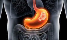 Mide kanserinin 10 belirtisine dikkat!